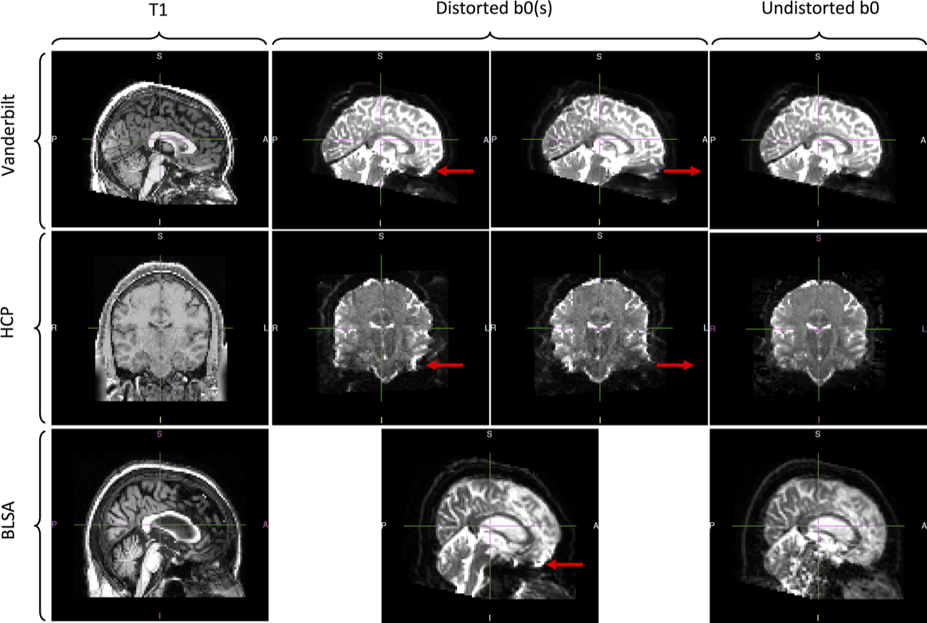 Susceptibility distortion correction figure